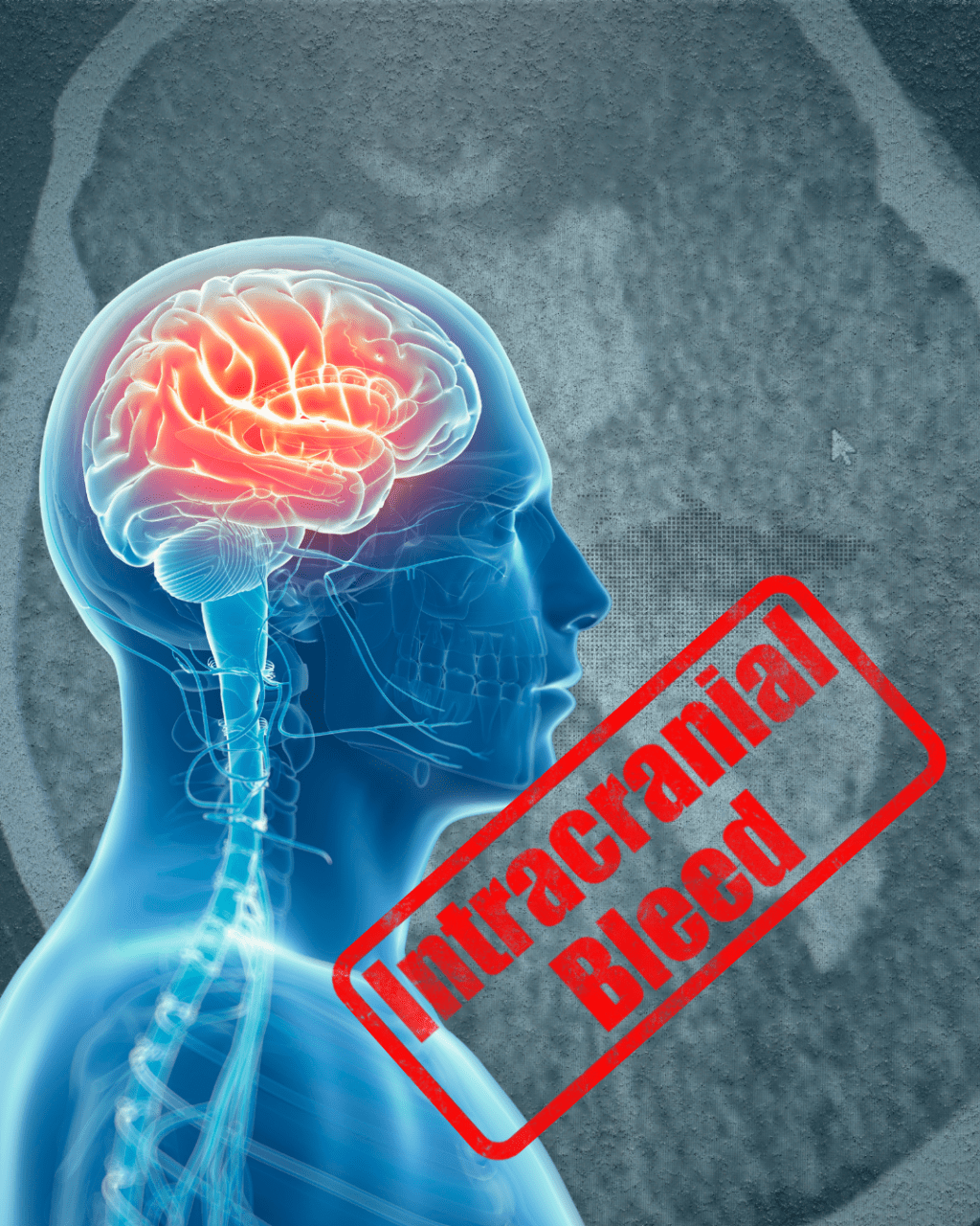 A Night in Stroke Care: Stability, Deterioration, and Reality