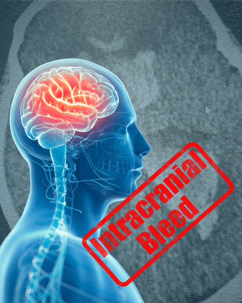 A Night in Stroke Care: Stability, Deterioration, and&nbsp;Reality